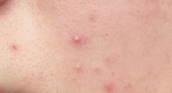 近年來祛痘類功效護(hù)膚品發(fā)展如何?